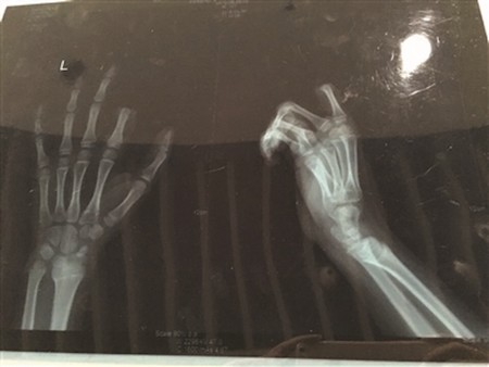 Ảnh chụp X-quang cho thấy đầu ngón trỏ trên bàn tay trái của Xiaopeng đã bị cắt rời