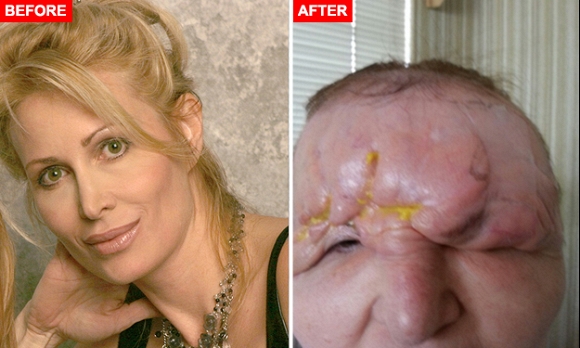  Cô gái bị biến dạng vì tiêm botox 0