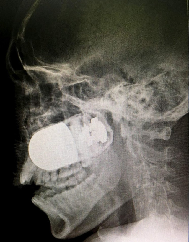  Cả một quả lựu đạn tìm thấy trong đầu của binh sĩ. 