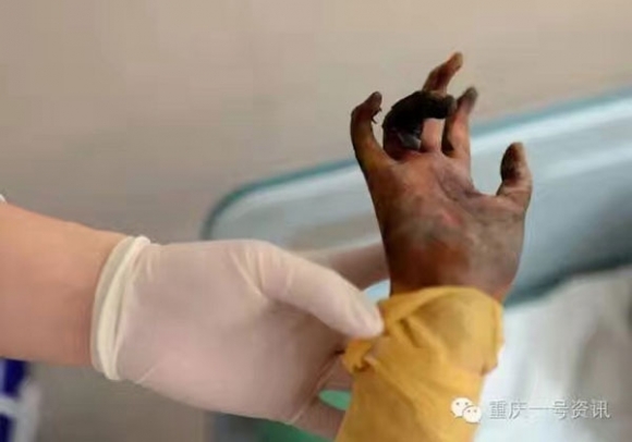 Bàn tay bị cháy đen sau đám cháy của bé Jiajia. Ảnh: China Daily