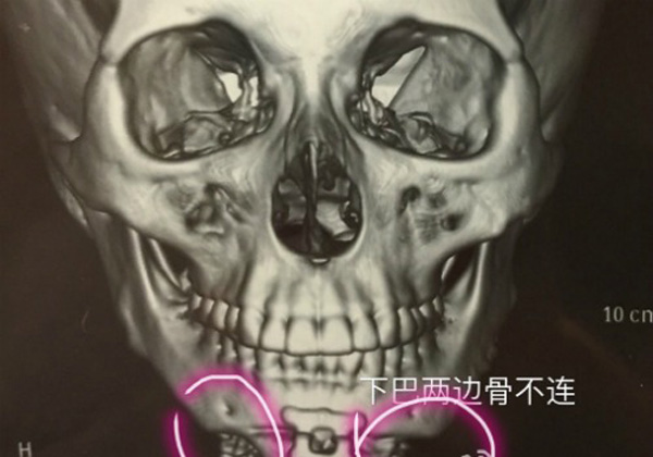 Phần cằm của Tutu có hai lỗ hổng lớn sau khi được bác sĩ Yu Dong phẫu thuật. Ảnh: whatsonweibo.