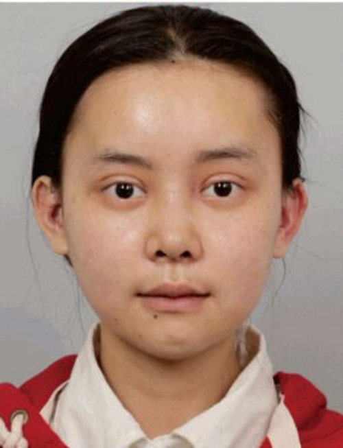 1 tháng sau khi phẫu thuật, khuôn mặt của Wu Yuqing vẫn còn sưng nề ở nhiều vị trí.