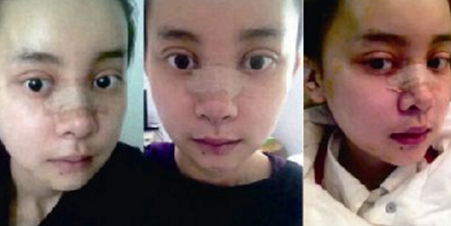 20 ngày sau ca đại phẫu, khuôn mặt của cô vẫn chưa hoàn toàn bình phục.