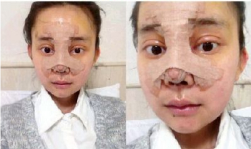 Khuôn mặt của Wu Yuqing 13 ngày sau khi phẫu thuật.