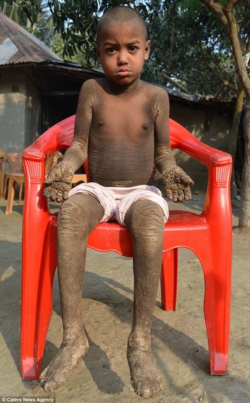 Chứng bệnh lạ khiến cả cơ thể cậu bé Mehendi bị bao phủ trong lớp da và vảy cứng như đá