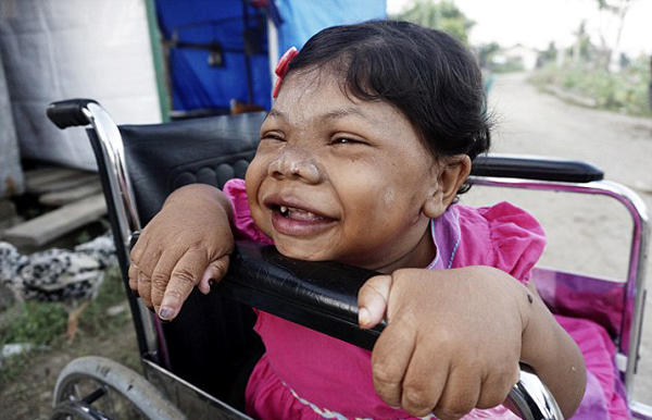 Sari Rezita Ariyanti phải ngồi trên xe lăn vì không thể tự đi lại. Ảnh: Barcroft