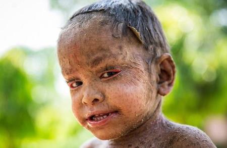 Vì căn bệnh lạ, cô bé 2 tuổi bị bong tróc từng mảng da đầu
