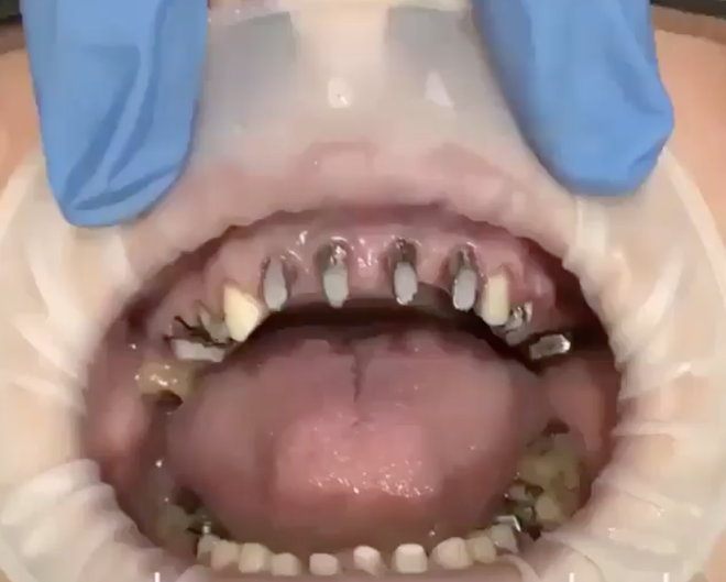 răng sứ - Ảnh 1.