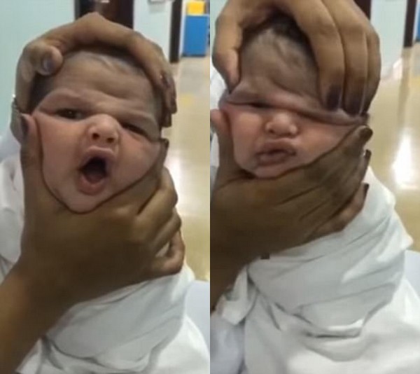 Gương mặt của em bé mới sinh bị bóp méo khiến nhiều người phẫn nộ