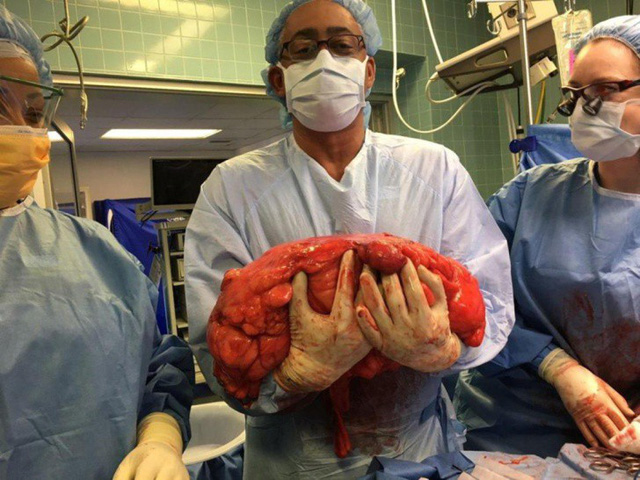 Bác sĩ chật vật ôm khối u lấy ra từ cơ thể Kevin bằng cả 2 bàn tay