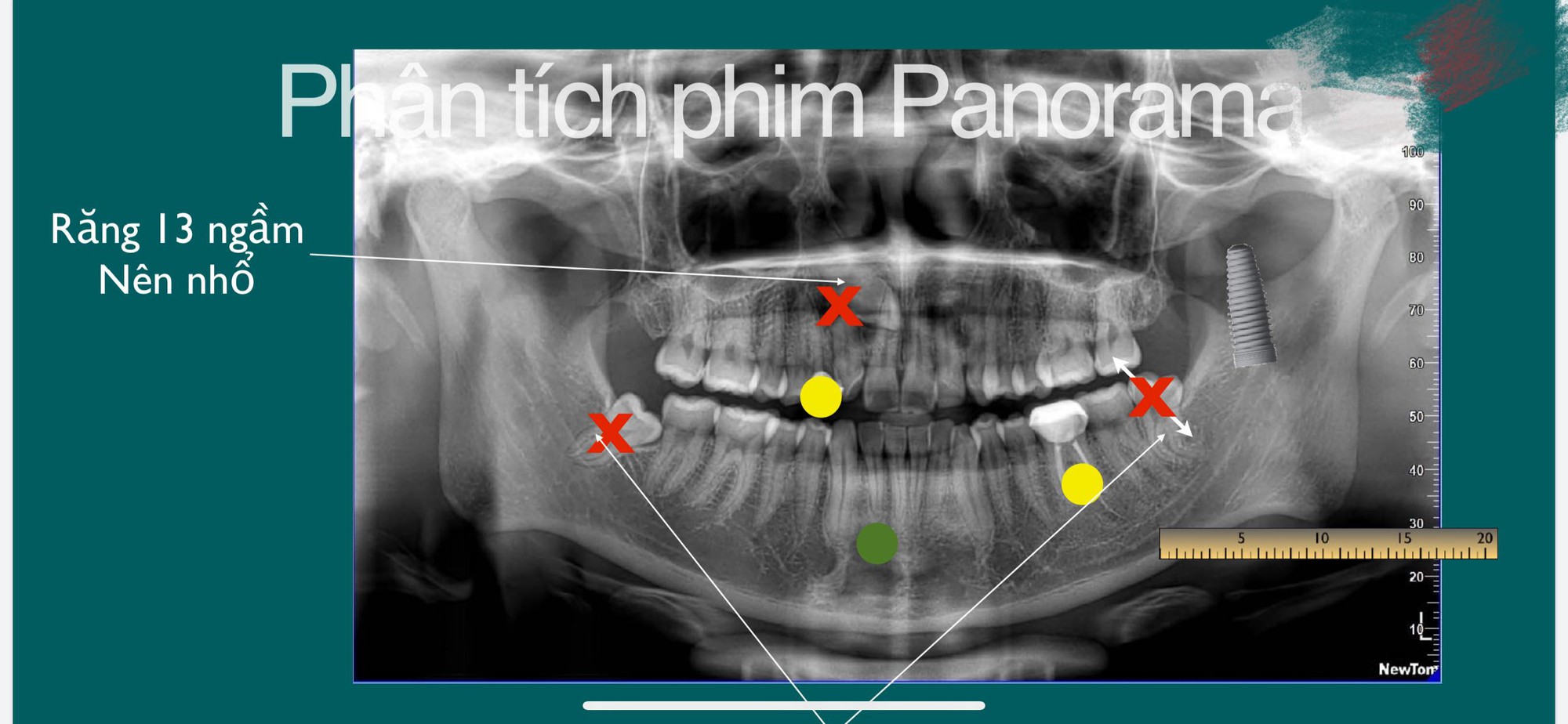 Tun Phạm khoe ảnh nhổ răng khôn và chứng minh nỗi khổ thấu trời xanh mà ai cũng gặp phải sau khi nhổ răng - Ảnh 3.