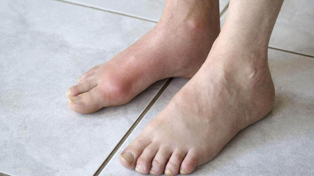 Cậu bé 13 tuổi mắc bệnh gout, nguyên nhân đến từ thức uống mà hầu hết đứa trẻ nào cũng ưa thích