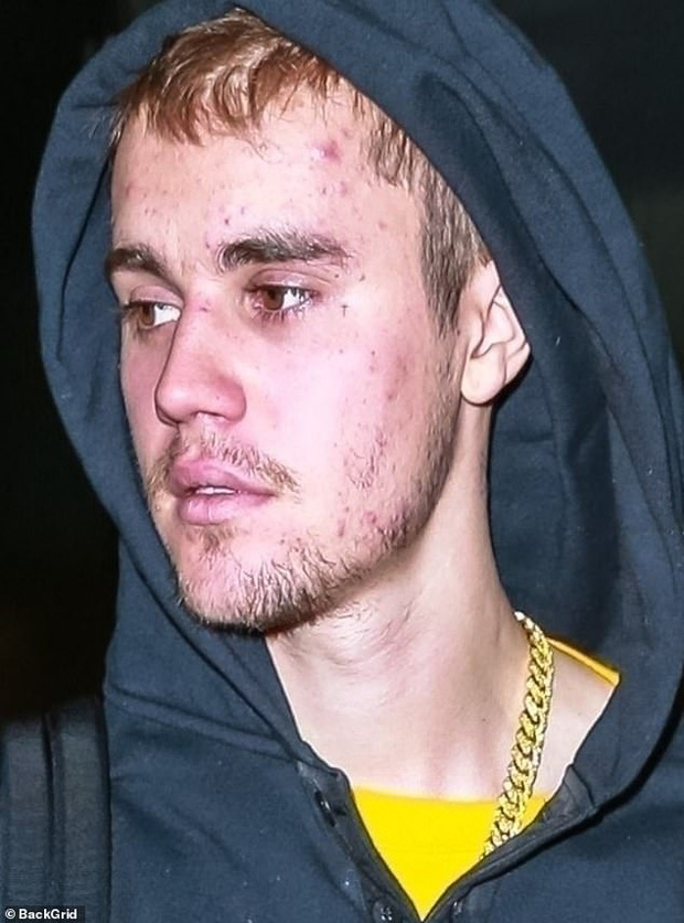 Bao năm bị tố lạm dụng ma tuý đá, Justin Bieber tiết lộ tình trạng sức khoẻ thật sự khiến nhan sắc tàn tạ - Ảnh 1.