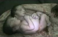 Cuộc sống ngắn ngủi của bé sơ sinh hai đầu Ấn Độ