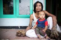 “Người cây” Indonesia qua đời khi chưa được làm thợ mộc