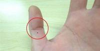 Giải mã tất tần tật về nốt ruồi trên ngón tay của bạn