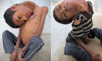 Ấn Độ: Sốc với cậu bé có thể gập ngược đầu