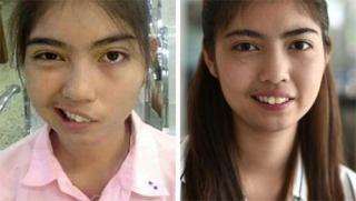 Nữ sinh Thái Lan biến dạng mặt vì bị thầy giáo ném cốc vào đầu