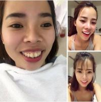 Cô gái Hà Nội chi 200 triệu  đập đi làm lại  toàn bộ gương mặt
