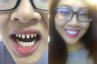Nếu tháo hết răng sứ, liệu có ai dám nhìn Nguyễn Thị Thành khi cười?
