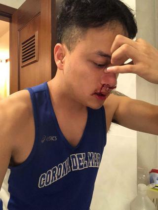 Cao Thái Sơn phải đi cấp cứu lúc nửa đêm vì cháy máu mũi